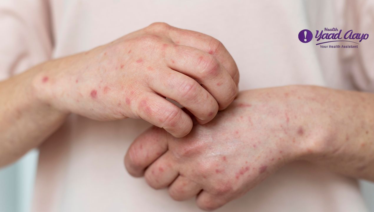 Is Monkey Pox Curable? Understanding Mpox, Symptoms, Treatment And Prevention